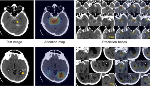 アルツハイマー病の診断を予測する深層学習